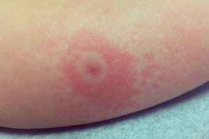 When it come to Lyme and “lyme like diseases”, what you and your doctor don’t know may harm you